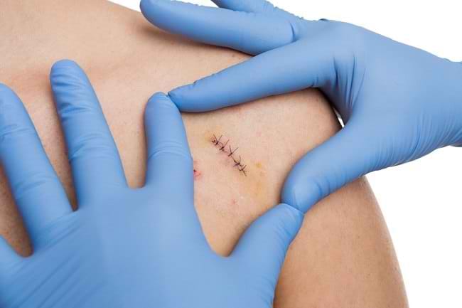 6 Tips Merawat Luka Jahitan agar Tidak Berbekas - Alodokter