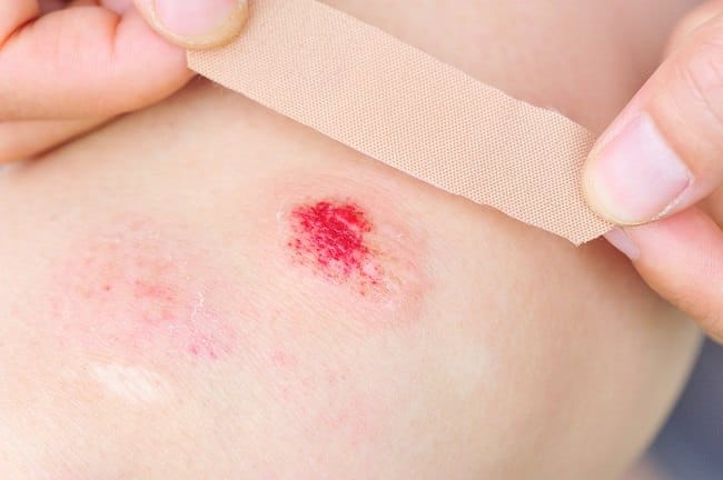 Waspadai Bakteri Pemakan Daging yang Bisa Mengancam Nyawa - Alodokter