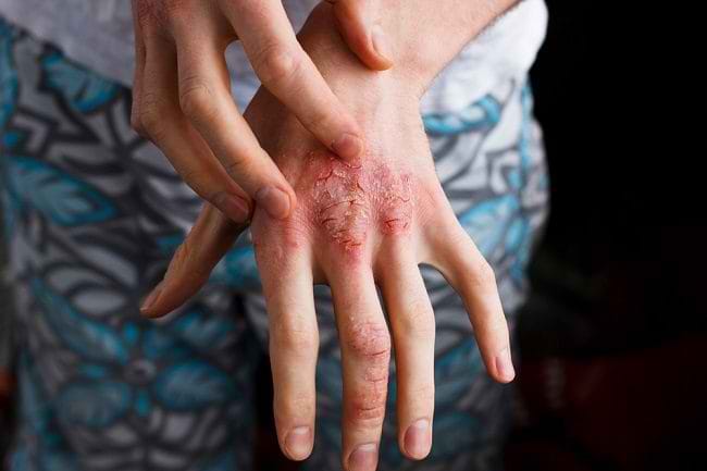 Macam-Macam Dermatitis yang Perlu Anda Ketahui - Alodokter