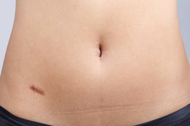 Hal yang Perlu Dilakukan Pascaoperasi Usus Buntu - Alodokter