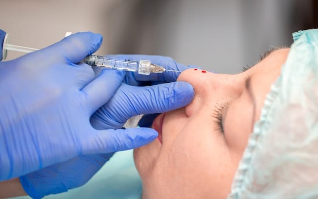 Seputar Filler Hidung yang Perlu Anda Ketahui - Alodokter