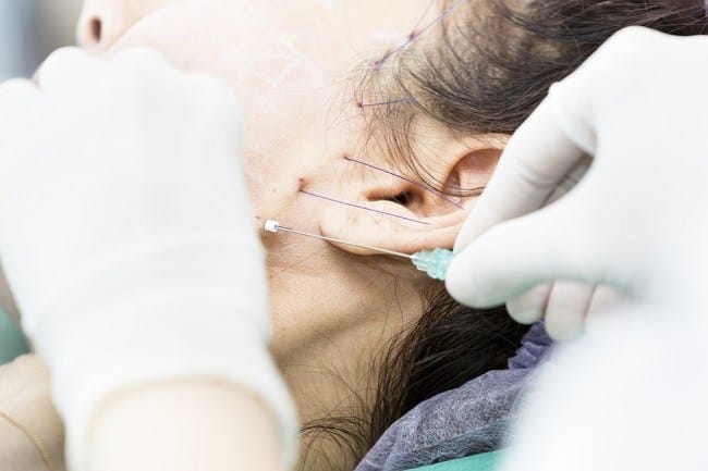 Tanam Benang, Ketahui Prosedur, Risiko, dan Tingkat Ketahanannya - Alodokter