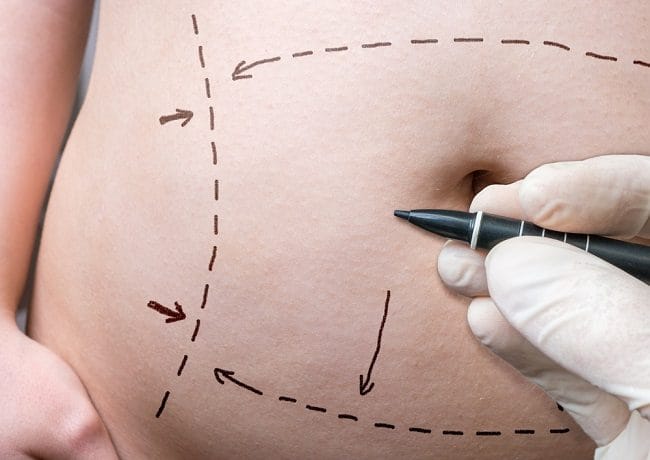 Tummy Tuck, Ini yang Harus Anda Ketahui - Alodokter