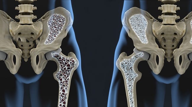 Kenali Jenis Osteoporosis dan Cara Mencegahnya - Alodokter