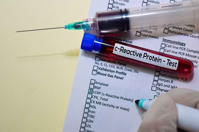 Seputar Pemeriksaan CRP dan Manfaatnya - Alodokter