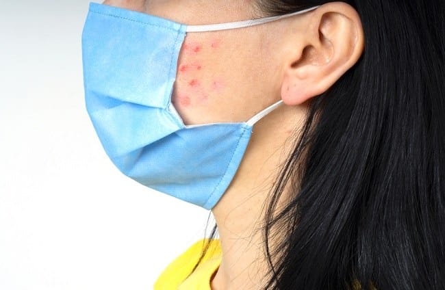Pakai Masker Seharian Sebabkan Skindemik, Ini Solusinya - Alodokter