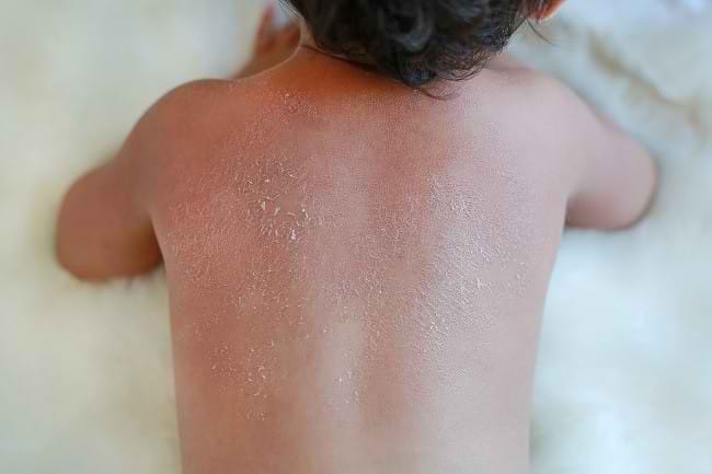 Harlequin Ichthyosis