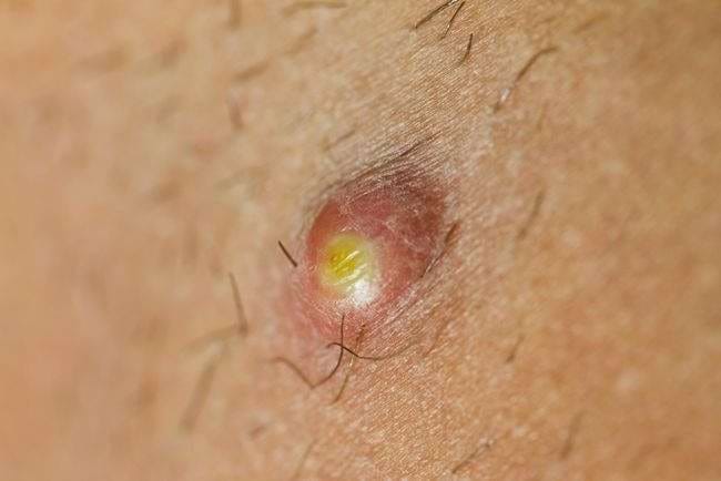 Folikulitis-alodokter