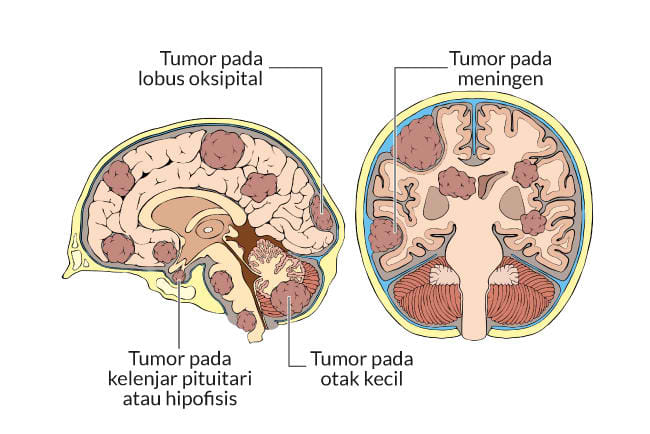 Kanker otak, gejala, penyebab, cara mengobati, cara mencegah, alodokter