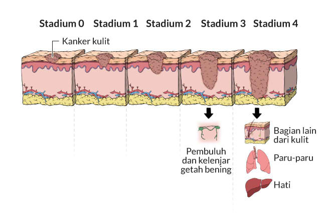 kanker kulit melanoma, gejala, penyebab, cara mencegah, cara mengobati, alodokter