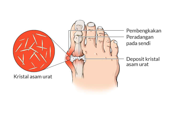 asam urat, penyakit asam urat, alodokter
