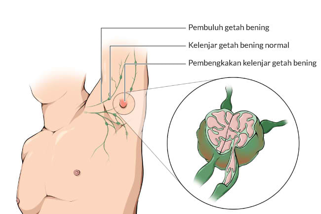 pembengkakan kelenjar getah bening, gejala, penyebab, cara mencegah, cara mengobati, alodokter