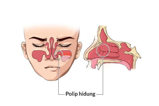 polip hidung, gejala, penyebab, cara mencegah, cara mengobati, alodokter