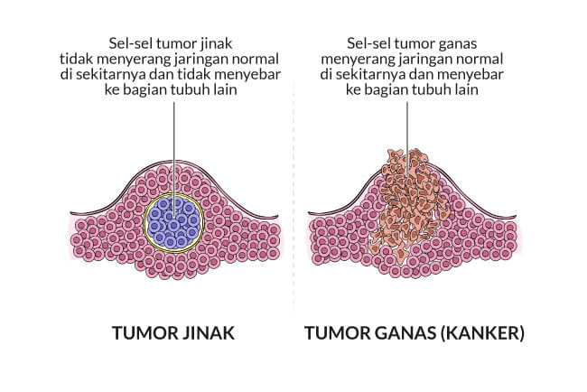 tumor, kanker, gejala, penyebab, cara mencegah, cara mengobati, alodokter