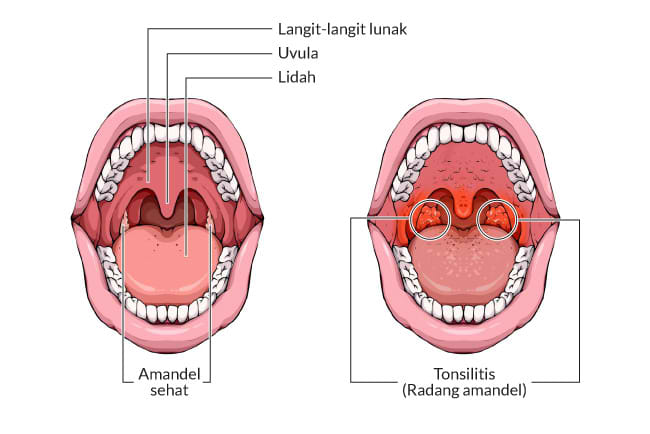 radang amandel, gejala, penyebab, cara mencegah, cara mengobati, alodokter