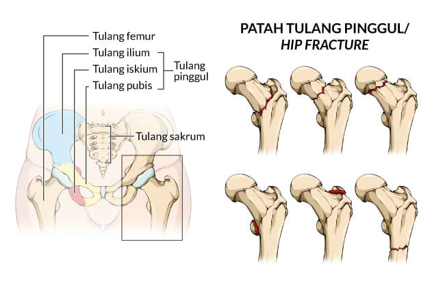 patah tulang pinggul, gejala, penyebab, cara mencegah, cara mengobati, alodokter