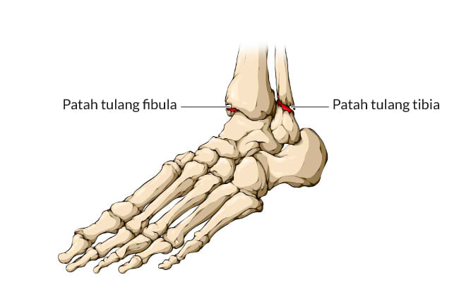 patah pergelangan kaki, gejala, penyebab, cara mencegah, cara mengobati, alodokter