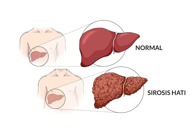 sirosis hati, gejala, penyebab, cara mencegah, cara mengobati, alodokter