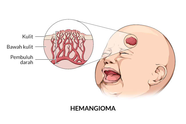 hemangioma, gejala, penyebab, cara mencegah, cara mengobati, alodokter