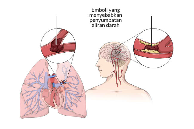emboli, gejala, penyebab, adalah, cara mencegah, cara mengobati, alodokter