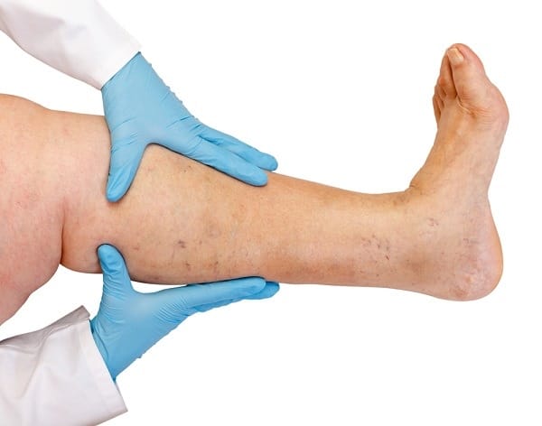 Chronic Venous Insufficiency
