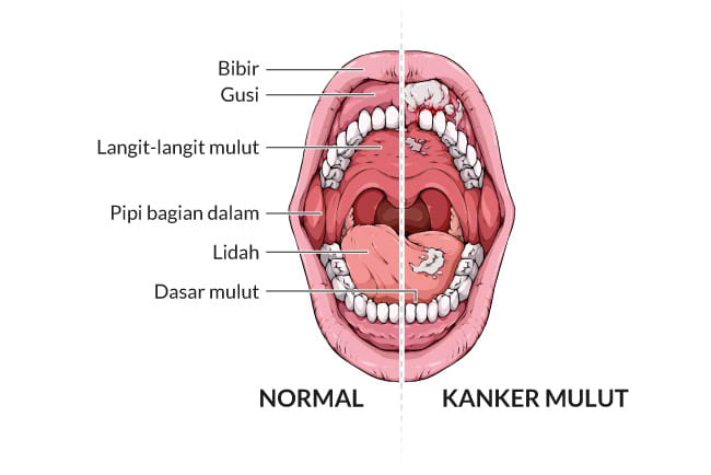 kanker mulut, gejala, penyebab, cara mencegah, cara mengobati, alodokter