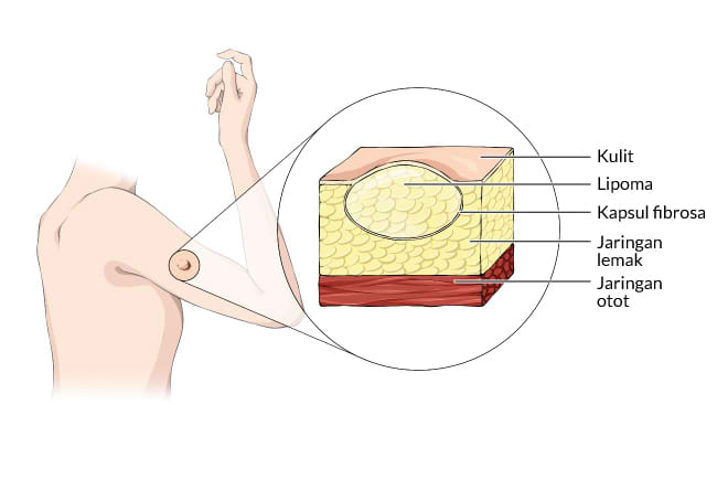 lipoma, gejala, penyebab, cara mencegah, cara mengobati, alodokter