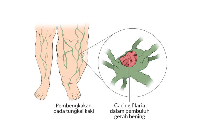 filariasis, kaki gajah, gejala, penyebab, cara mencegah, cara mengobati, alodokter