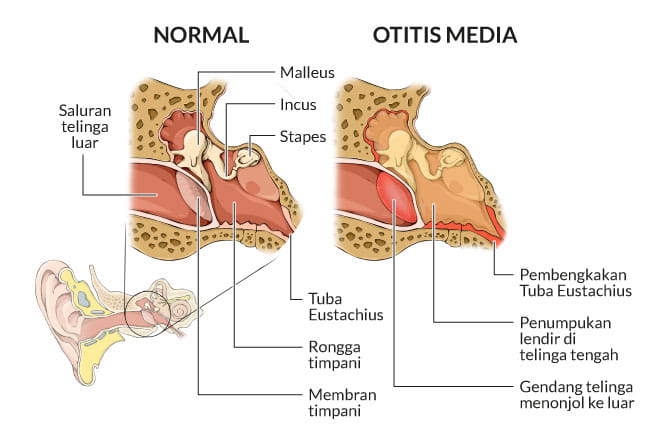 otitis media, gejala, penyebab, cara mencegah, cara mengobati, alodokter