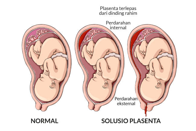 solusio plasenta, gejala, penyebab, cara mencegah, cara mengobati, alodokter