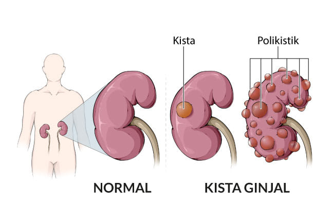 kista ginjal, gejala, penyebab, cara mencegah, cara mengobati, alodokter