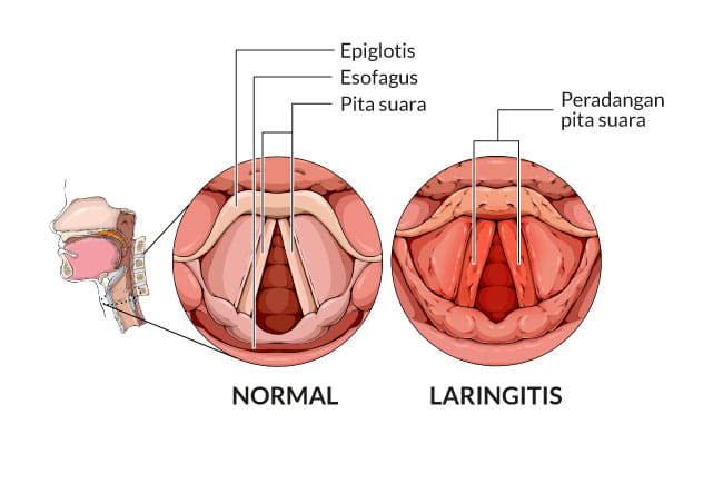 laringitis, gejala, penyebab, cara mencegah, cara mengobati, alodokter