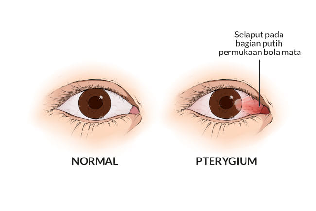 pterygium, gejala, penyebab, cara mencegah, cara mengobati, alodokter