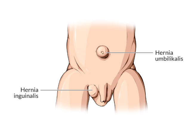 Hernia pada Bayi, Kenali Tanda dan Gejalanya - Alodokter
