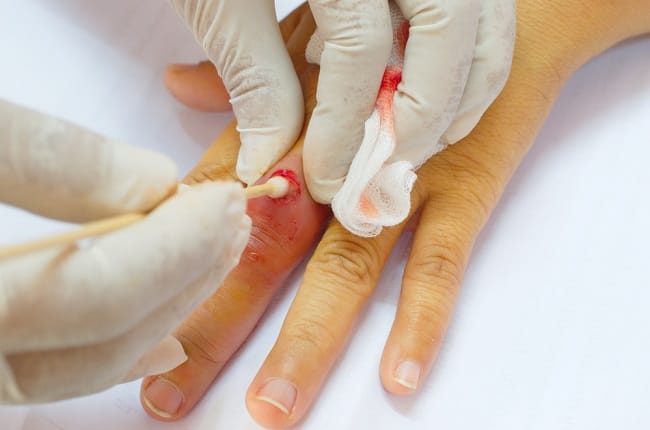 cleaned abscess wound