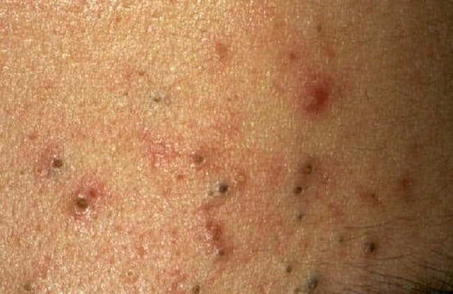 Komedo Hitam - Alodokter