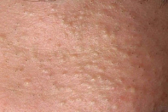 Komedo Putih - Alodokter