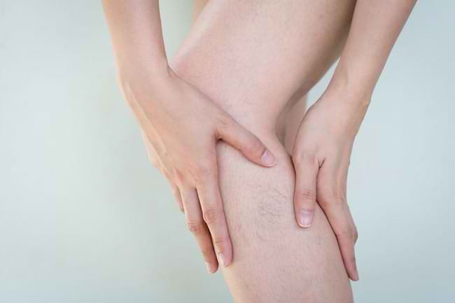 Cara Menghilangkan Varises secara Mandiri maupun Medis - Alodokter