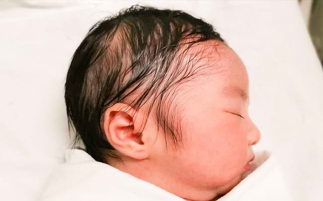Penyebab Rambut Bayi Baru Lahir Rontok dan Cara Mengatasinya - Alodokter