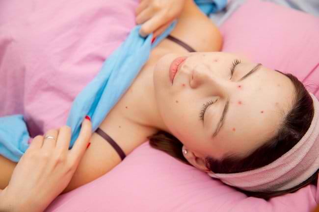 Cacar Air Dewasa Beserta Langkah Penanganan dan Pencegahannya - Alodokter