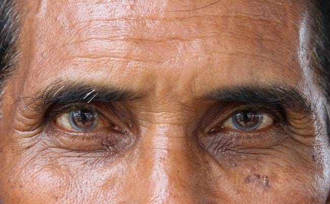 Katarak pada Lansia - Alodokter