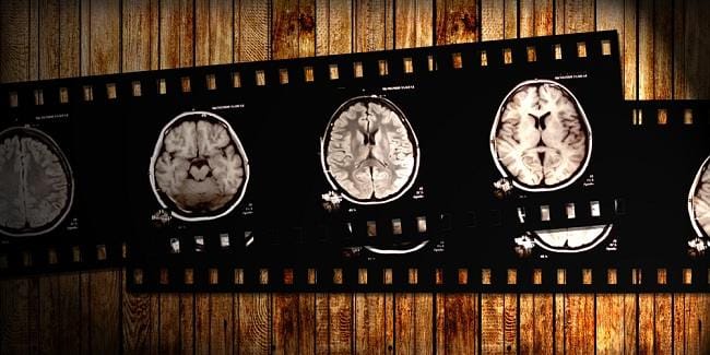 Macam-Macam Infeksi Otak dan Faktor Risikonya - Alodokter