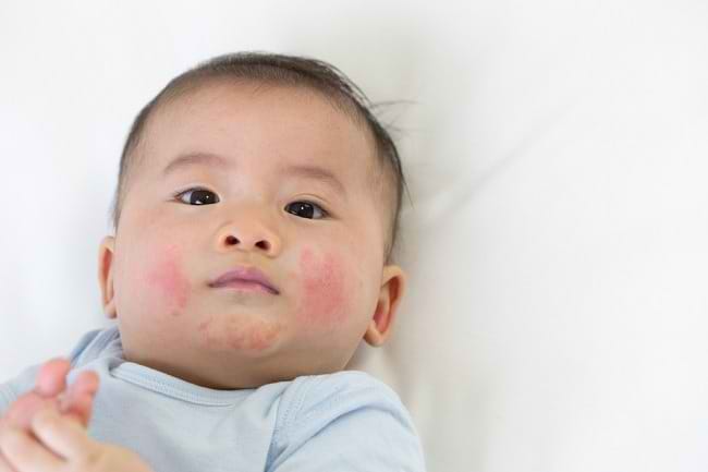 Roseola Infantum, Penyakit yang Mudah Menular pada Bayi - Alodokter