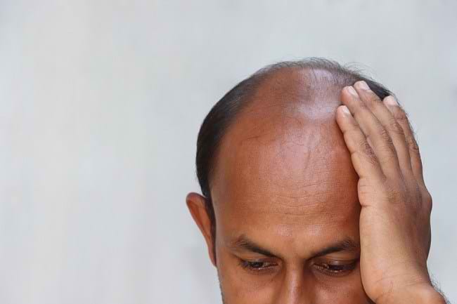 Kepala Botak pada Pria, Inilah 7 Penyebab dan Cara Mencegahnya - Alodokter