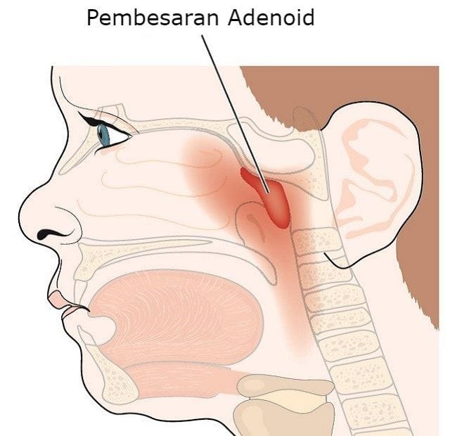 Pembesaran Adenoid - Alodokter
