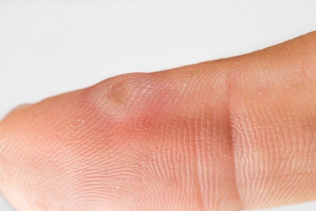 Epidermolysis bullosa - alodokter