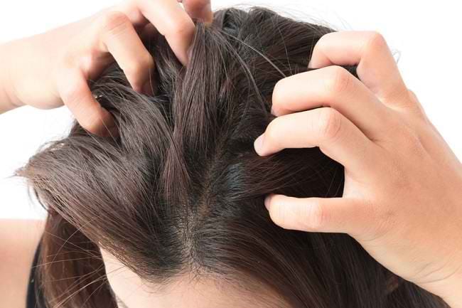 Cara Menghilangkan Kutu Rambut dengan Minyak Kayu Putih - Alodokter