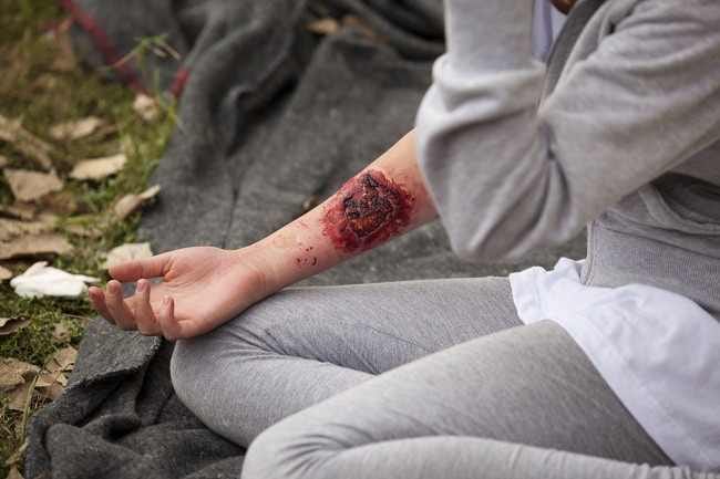 Luka Bakar - Alodokter