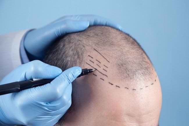 Prosedur Transplantasi Rambut dan Risiko yang Dapat Terjadi - Alodokter
