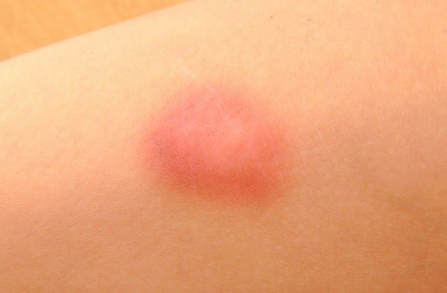 Pertolongan Pertama pada Luka Memar - Alodokter